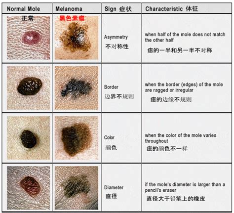 陰囊有痣|陰囊上的痣：是否需要切片檢查和去除？